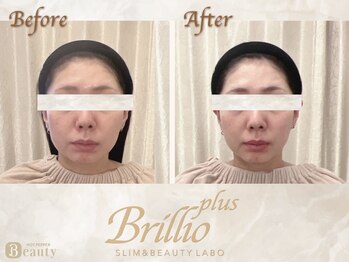 ブリリオプラス ナラ(Brillio plus NARA)/"究極のエイジングケアコース"