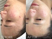 サロンブランシュ(salon BLANCHE)/CHRISTINA【赤み・ニキビケア】