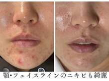 ハーブピーリングHYの雰囲気（繰り返す肌荒れを根本的に改善します◎）