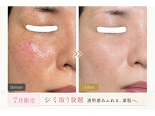 ココスタイルビューティー(COCOSTYLE beauty)の雰囲気（シミケアスポット！赤ら顔ケア）