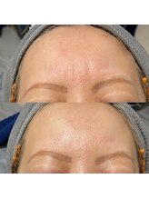 bou 新宿/眉間が気になる！