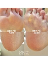 ニコプラス(NICO+)/足裏角質除去