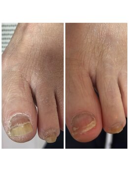 肥厚爪ケア