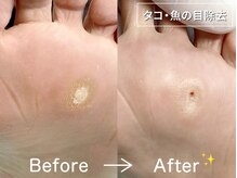 ディオフット(DIO FOOT)/硬くなった[タコ・魚の目]の除去