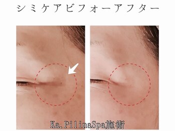 カピリナスパ(Ka.Pilina Spa)/シミケア1回目 before⇒after
