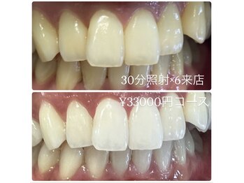 ホワイトニングルーム 横浜店(Whitening Room)/ホワイトニング/横浜