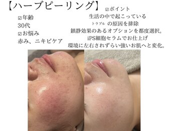 サロンツキ(salon tuki)/ハーブピーリング症例/徳島