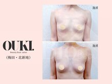 オウキ 梅田北新地(OUKI.)/バストアップ結果写真