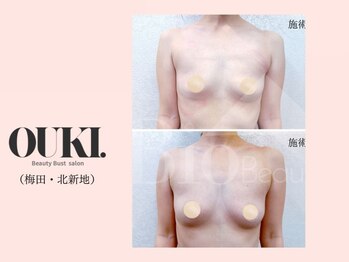オウキ 梅田北新地(OUKI.)/バストアップ結果写真
