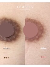 エルビービュティーサロン(LB BEAUTY SALON)/【ルメラ乳輪】実績数関西1★