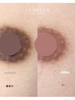 エルビービュティーサロン(LB BEAUTY SALON)/【ルメラ乳輪】実績数関西1★