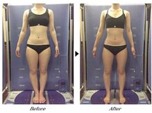 ビューティークリニックコダマ 宮崎本店/【2か月コース】M.H様（21歳）