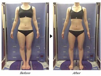 ビューティークリニックコダマ 宮崎本店/【2か月コース】M.H様（21歳）