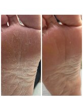 ドクターネイル爪革命 十条店/角質ケア