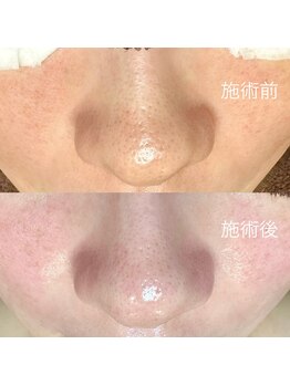 エクラ バイ シャンリィ(eclat by shanLy)/トーンアップ