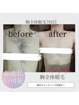 ネクスト 伊勢店(NEXT)/胸全体脱毛