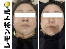 ブレア(Blair)/脂肪分解液＋顔のむくみ取り