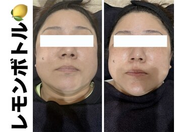 ブレア(Blair)/脂肪分解液＋顔のむくみ取り