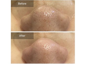 リジュベ(Rejuve)/毛穴エクストラクション[本八幡]