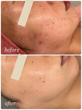 プレジール(Plaisir)/韓国人気No. 1 XE'LHAセラピール