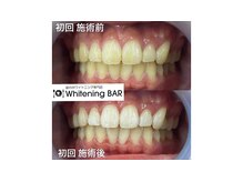 ホワイトニングバー 心斎橋オーパ店/初回でも効果を実感！