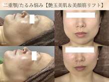 エミルカ 仙台(EMILUCA)の雰囲気（人気No1♪30代からの年齢悩みに◎リフトアップならお任せ！）