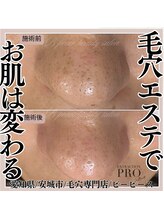 ビーピース(B peace)/毛穴エクストラクションプロ