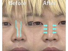 ラプリ 大宮店(Raplit)/隆鼻＋輪郭矯正40分10回