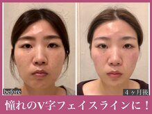 アクアビー(AQUA-B)/輪郭・肌の改善例【金剛/小顔】