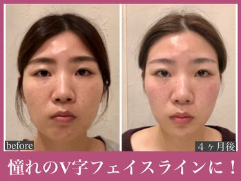 アクアビー(AQUA-B)/輪郭・肌の改善例【金剛/小顔】