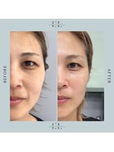 縁(エニシ)/最新美容　Exo &nbsp;Lift &nbsp;