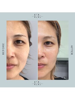 縁(エニシ)/最新美容　Exo  Lift  