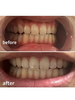 ダンニヒル(dannihil)/セルフホワイトニング