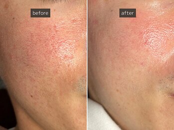 SEC(Shizuoka esthetic company)/【赤み/毛穴】