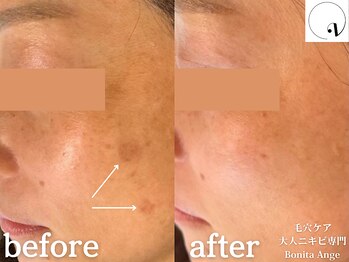 ボニータアンジュ 恵比寿(Bonita Ange)/恵比寿ハーブピーリング｜症例