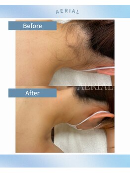 エアリアル 武雄店/えりあし脱毛