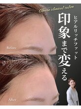 シェリー(Cherie)/30代額の窪みを丸く