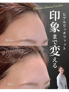 シェリー(Cherie)/30代額の窪みを丸く