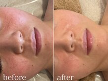 グレイティア(gratia)/光フォト&バクテリウムピール