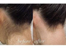 サンゴーハチ(358)/《うなじ脱毛》