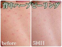 スイ 昭島店(Sui)の雰囲気（自分では手の届かない背中ニキビ・毛穴・黒ずみを根本改善。）