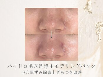 アネラボーテ(Anela Beaute)/ラフォス＋ハイドロ毛穴洗浄