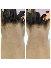 キアラ 麻布十番(Kiara)/うなじ脱毛麻布十番/毛穴/顔脱毛