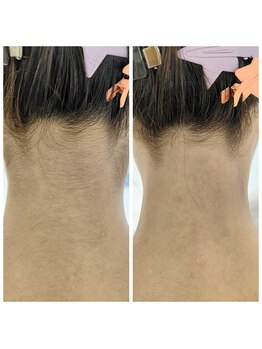 キアラ 麻布十番(Kiara)/うなじ脱毛麻布十番/毛穴/顔脱毛