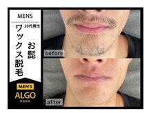 アルゴ 南茨木駅前店(ALGO)/【メンズ髭脱毛】