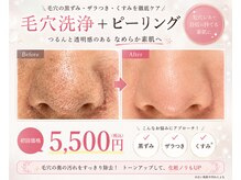 レアマカナ(LeaMakana)の雰囲気（【毛穴洗浄＋ピーリング】ビフォーアフター）