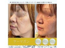 泡のきもちの雰囲気（人気NO.1◎高周波サーマガンでリフトアップ◎たるみ改善◎）
