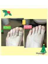 リゼラアンドコー 宇都宮店/巻き爪/肥厚爪、ネイルケア