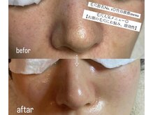 ヴィディトゥ(vidyto)/人気毛穴改善コース＋エンビロン