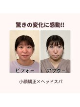 プレシャス(PRECIOUS)/小顔矯正